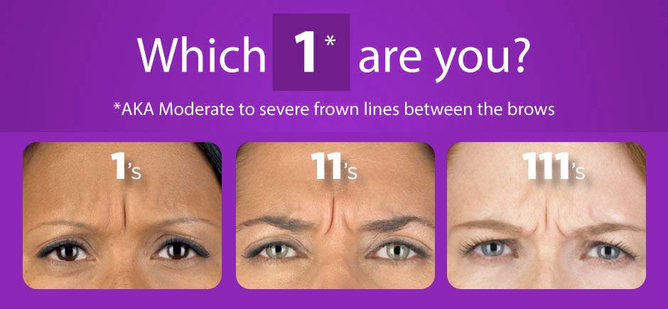 Botox treatment for forehead wrinkles in Charlotte, NC