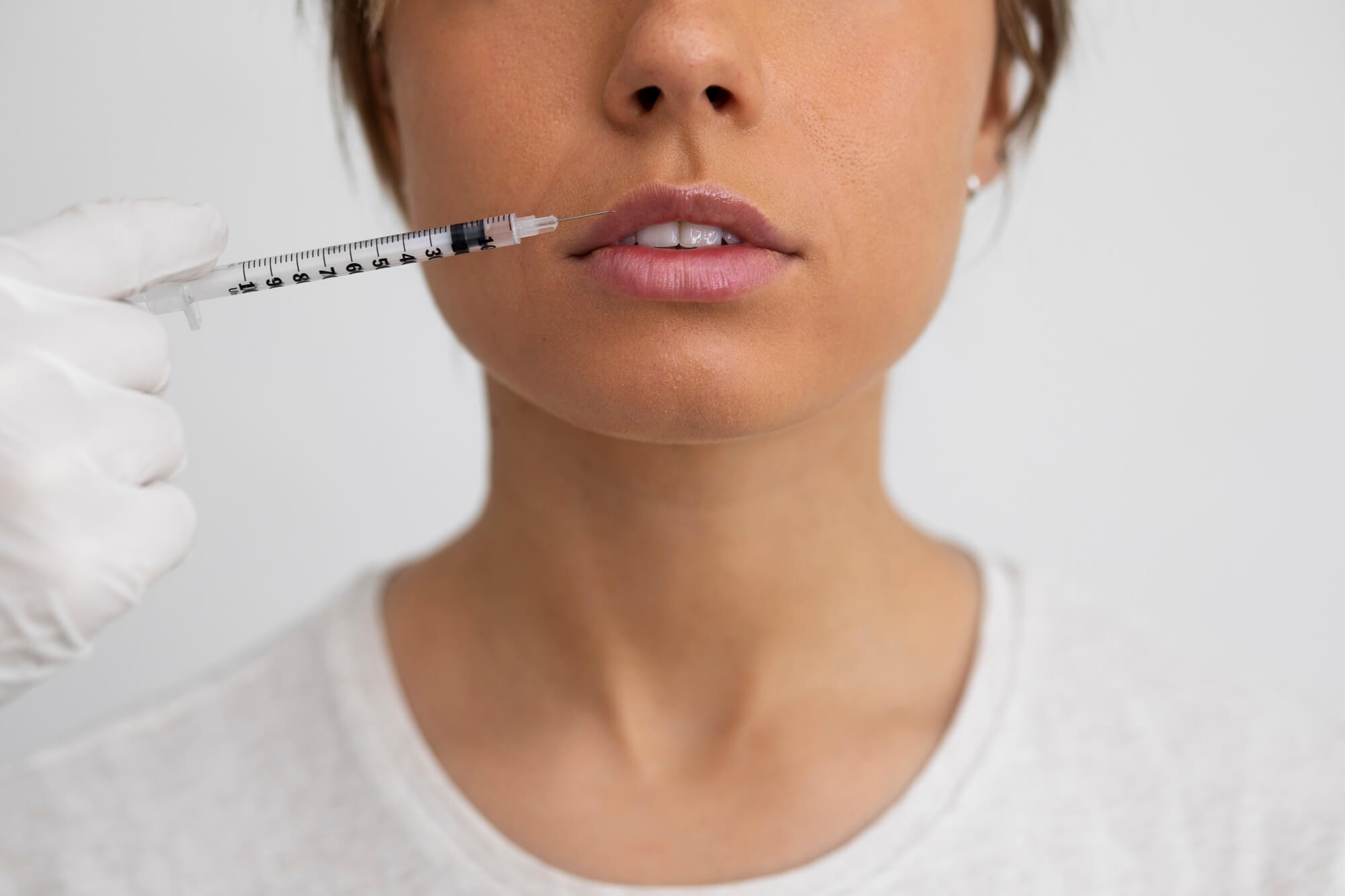 Dermal filler injections for smile lines in Charlotte, North Carolina Dermal filler injections for smile lines in Charlotte, North Carolina